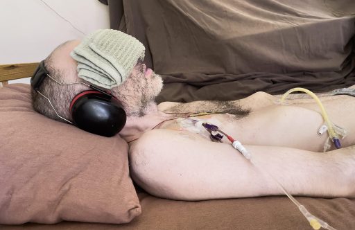 Whitney- Severe ME_CFS The image shows Whitney laying in a bed on a brown pillow with a towel over his eyes. On the right side of his chest, he has a medical tube attached.